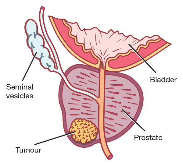 further detailed information on treatment and side effects pcfa