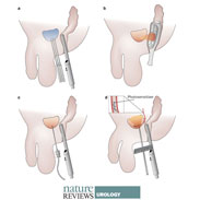 A Focus on Focal Therapies