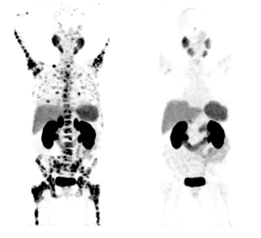 Theranostics For Prostate Cancer Inline