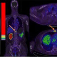 New Radiotracer Could Make Diagnosing Prostate Cancer Faster and Easier