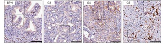 Neuropilin 1 Aggressive Prostate Cancer Inline