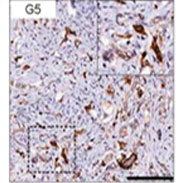 Neuropilin-1 is Produced by Aggressive Prostate Cancers