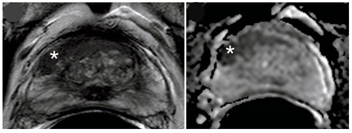 The MRI-FIRST study demonstrates the benefit of combined biopsy techniques