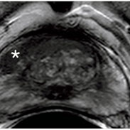 Will multi-parametric MRI live up to its PROMIS in Australia?