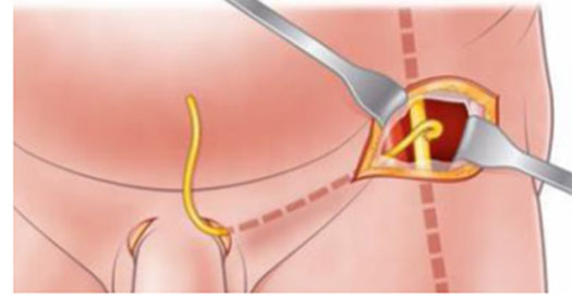 A new surgical technique to restore sexual function after prostate surgery