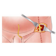 A new surgical technique to restore sexual function after prostate surgery