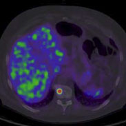 New PSMA PET/CT imaging technology tested in an Australian phase 1 trial