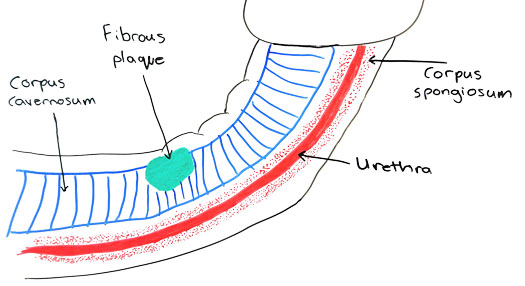 Peyronie’s disease in men with prostate cancer