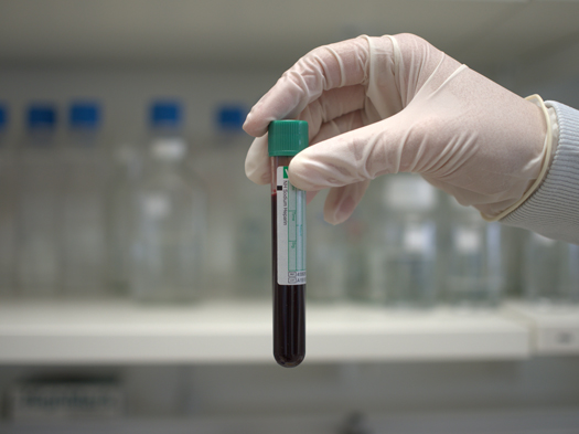 New progress in the development of liquid biopsies for prostate cancer
