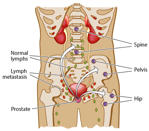 Apalutamide improves survival times in men with metastatic prostate cancer when used with hormone therapy.