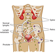 Apalutamide improves survival times in men with metastatic prostate cancer