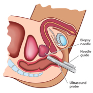 Can a biopsy spread prostate cancer?