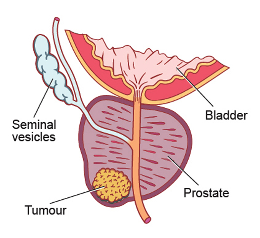 Finasteride for the prevention of prostate cancer