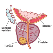 Finasteride for the prevention of prostate cancer