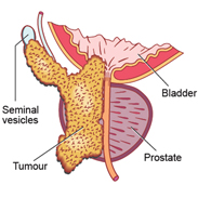 Best treatments for locally advanced prostate cancer