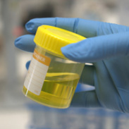 A promising new urine test for prostate cancer is being developed