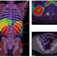Benefits of PSMA-PET scans for prostate cancer diagnosis