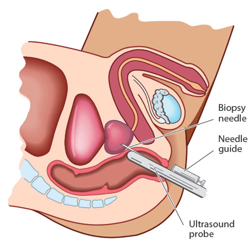 Prostate biopsy